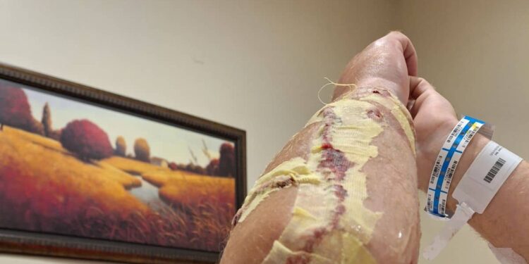 Attacked by an alligator, he almost lost his arm