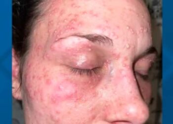 Face held in red ant nest: mother sues Sante Fe police