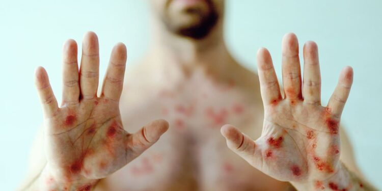 Monkey pox: American public health on alert