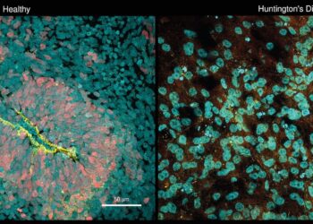 Brain organoid model implicates gene in disease progression