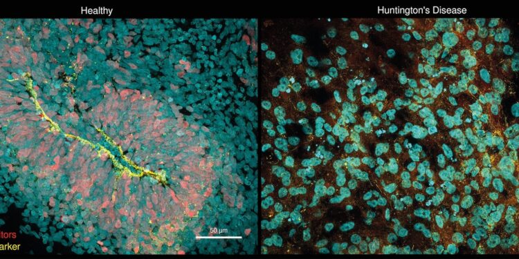 Brain organoid model implicates gene in disease progression