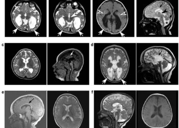 Discovery brings answers to parents of children with rare neurological genetic mutation
