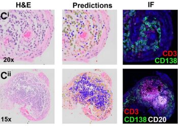 Machine learning helps identify subtypes of rheumatoid arthritis