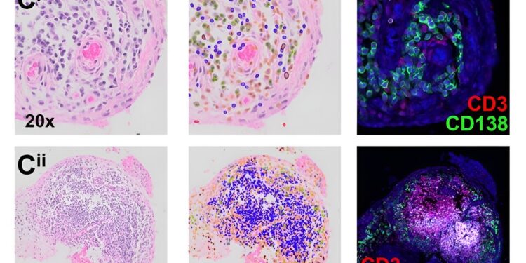 Machine learning helps identify subtypes of rheumatoid arthritis