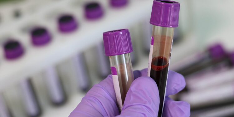 Single blood test predicts 30-year cardiovascular disease risk in women