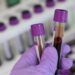 Single blood test predicts 30-year cardiovascular disease risk in women