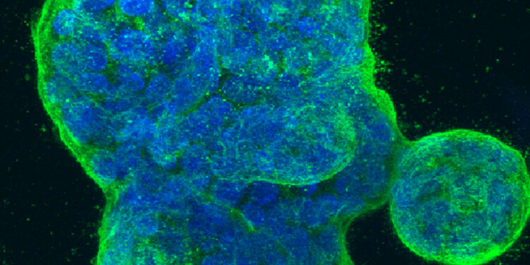AI could predict breast cancer risk using ‘zombie cells’