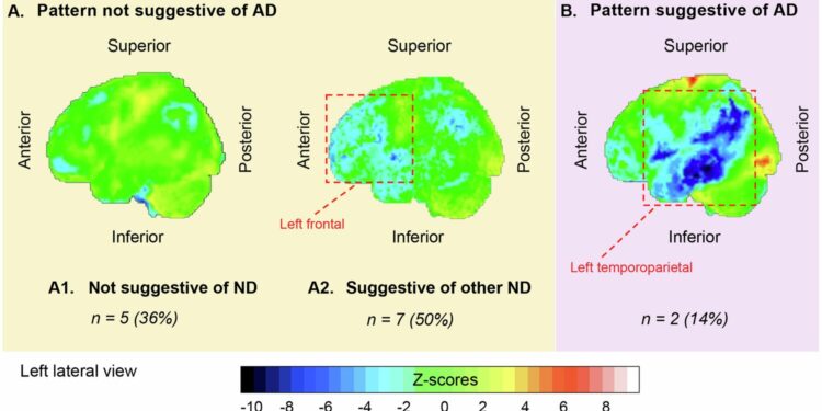 Alzheimer’s Disease Study Finds Critical Differences in Memory Loss Progression Based on Presence of Specific Proteins