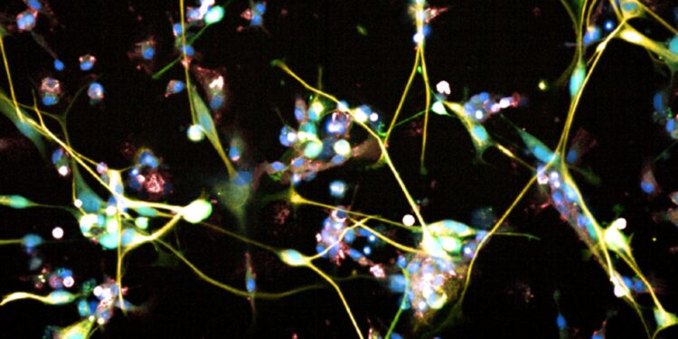 Antidepressant shows promise for treating brain tumors