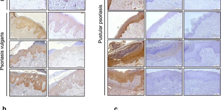 Faulty iron hormone in the skin may cause psoriasis