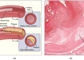 Metals in the body from pollutants associated with the progression of harmful plaque buildup in the arteries