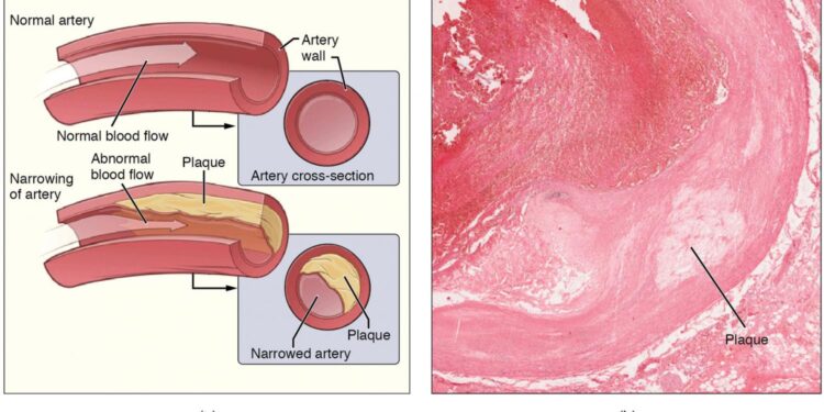 Metals in the body from pollutants associated with the progression of harmful plaque buildup in the arteries