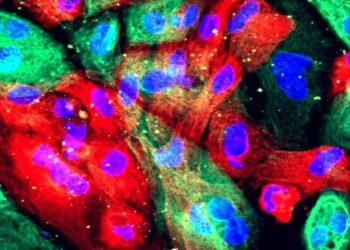 NSD2 protein may be responsible for early development of prostate cancer