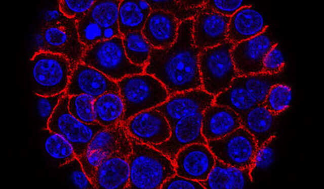 Pancreatic Cancer Study Finds Most Early Stages Are Inaccurate