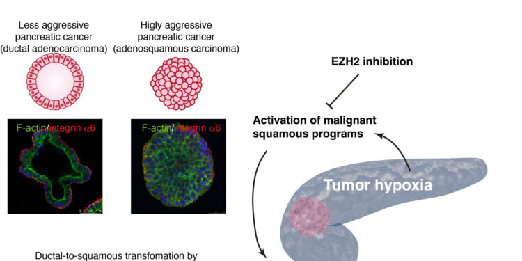 Pancreatic cancers change identity as they transform into aggressive types, organoid study reveals