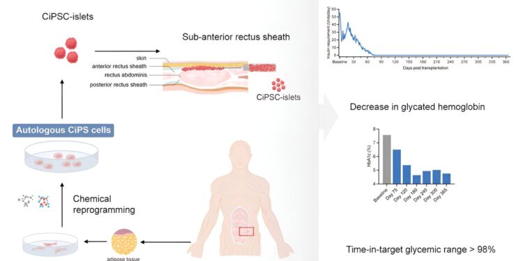 Patient with type 1 diabetes functionally cured thanks to stem cell injections