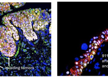 Promising drug combination targets aggressive bladder cancers