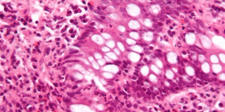 Researchers discover new bacteria responsible for intestinal immunodeficiency