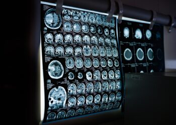 Scientists discover key features of language sites that could help preserve function after brain surgery