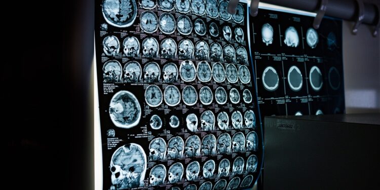 Scientists discover key features of language sites that could help preserve function after brain surgery