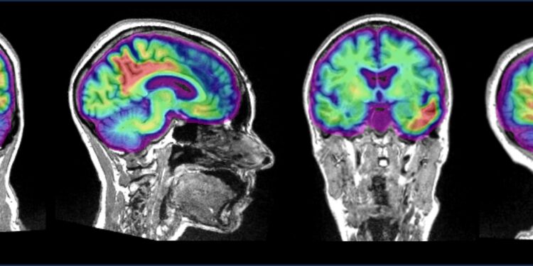 Study finds two proteins impact brain activity differently