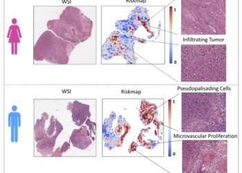 AI model shows potential to identify sex-specific risks associated with brain tumors