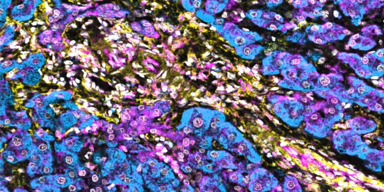Biomarker can predict response to immunotherapy in liver cancer