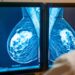 Increase in the number of cases of breast cancer among women under 50