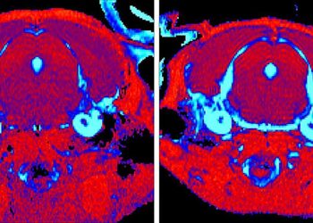 New treatment for Gaucher disease shows promise