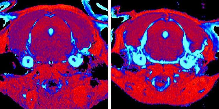 New treatment for Gaucher disease shows promise