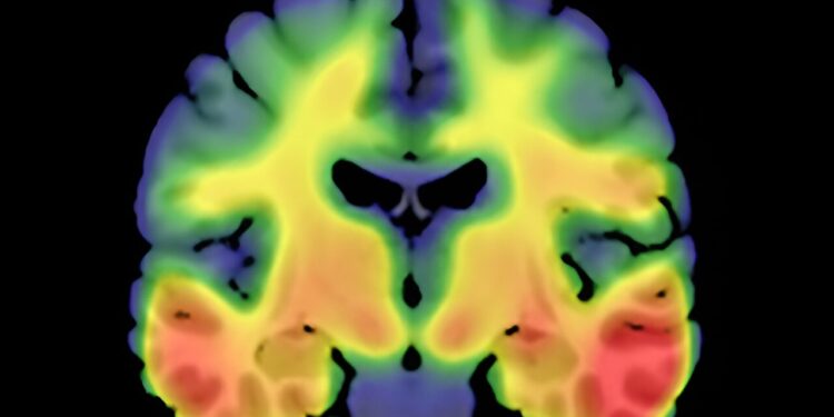 Newly discovered genetic marker could pave the way for future treatments for Alzheimer’s disease