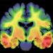 Newly discovered genetic marker could pave the way for future treatments for Alzheimer’s disease