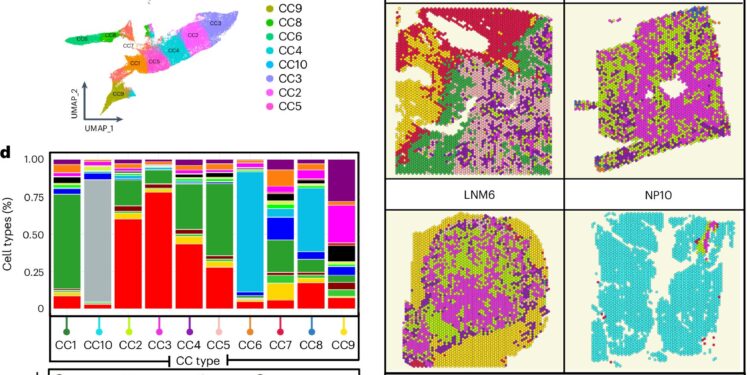 Pancreatic cancer tumor map reveals notable differences between primary and metastatic disease