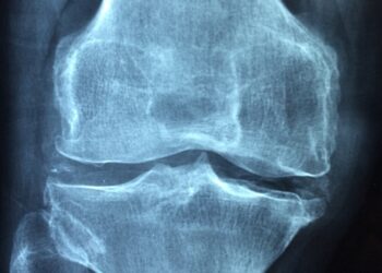 Proteins blocking bone development could provide clues for future osteoporosis treatment