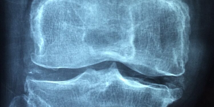 Proteins blocking bone development could provide clues for future osteoporosis treatment