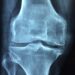 Proteins blocking bone development could provide clues for future osteoporosis treatment