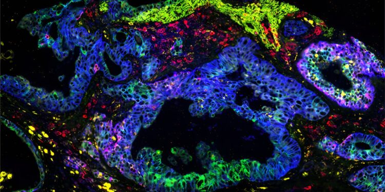 Researchers develop analyzes of KRAS mutations in pancreatic cancers