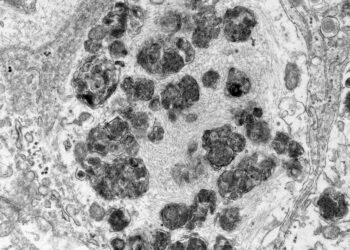 Scientists use stem cells to recreate a hallmark of Parkinson’s disease in human neurons