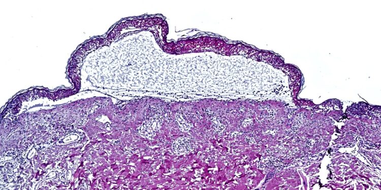 Spatial proteomics approach leads to life-saving treatment for deadly skin reaction