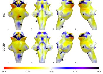 Ultra-powerful MRIs show damage to brain ‘control center’ causes persistent COVID-19 symptoms