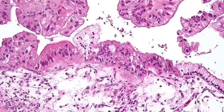 Ultrasound test detects 96% of ovarian cancers in postmenopausal women