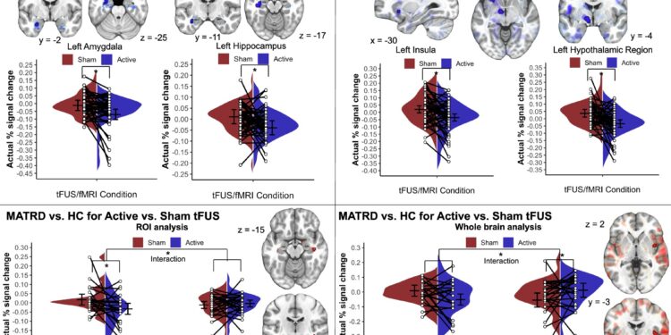 A new non -invasive cerebral stimulation technique shows a significant reduction in depression, anxiety and SSPT symptoms