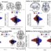 A new non -invasive cerebral stimulation technique shows a significant reduction in depression, anxiety and SSPT symptoms