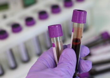 RNA -based blood test identifies parkinson before the appearance of symptoms