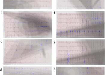 The AI ​​tool interprets ECG images with precision at the pixel level