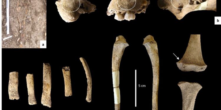 The study discovers mercury treatment in the French child of the 19th century suffering from Ricotte and Scorbut