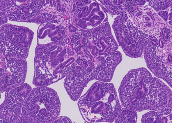 Child’s kidney cancer has millions of genetic changes, opening the door to possible treatments