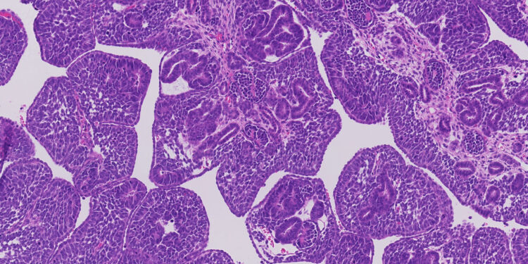 Child’s kidney cancer has millions of genetic changes, opening the door to possible treatments