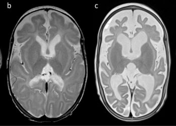 Premature infants suffering from drug -resistant crises responds to oligonucleotide antissens treatment