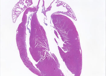 Precise gene editing technique modifies a DNA base to correct heart disease